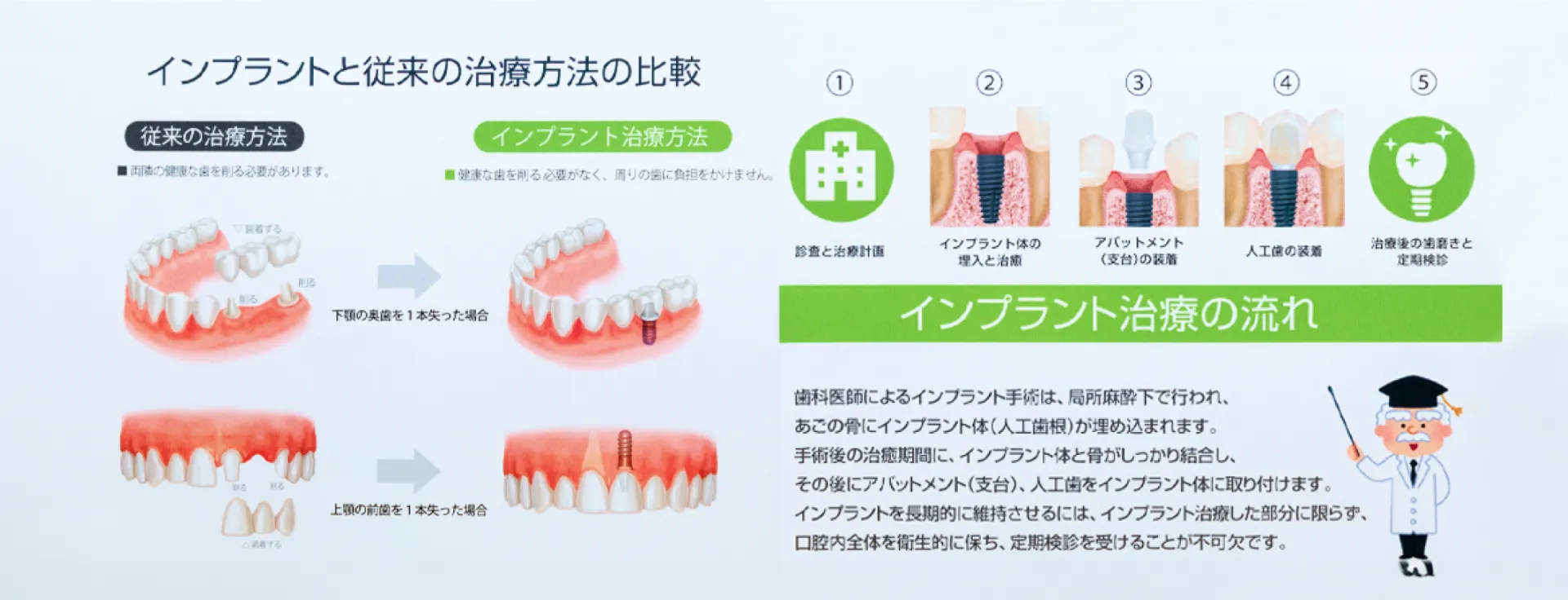 インプラントと従来の治療法の比較